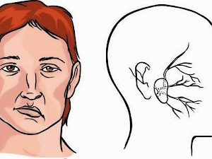 Tratamiento de la parálisis facial
