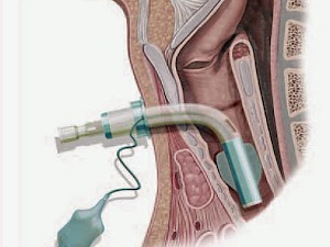 Manejo de la cánula traqueal (disfagia severa). Parte 1ª.
