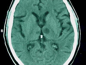 ¿Qué es la demencia vascular?